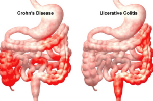 Ulcerative Colitis and Crohns 