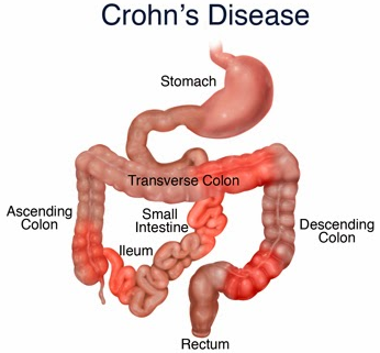 Crohn's Disease Treatment and Therapy