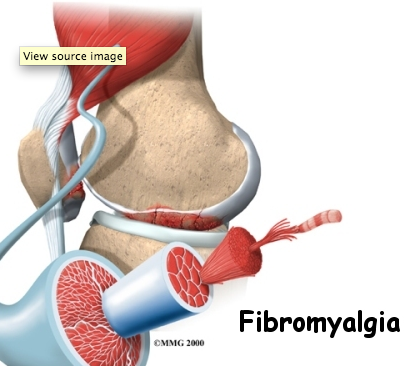 fibromyalgia nerve pain