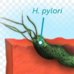 h pylori crohn's disease