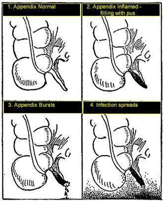 appendicitis stages