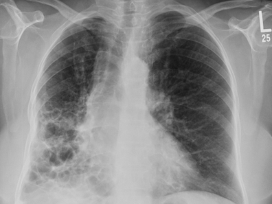 Bronchiectasis disease lung xray