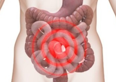 ulcerative colitis spasms of the intestine and colon