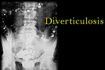 diverticulosis xray
