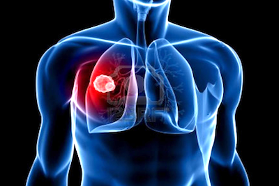 mesothelioma cancer chest xray