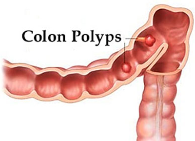 colon polys