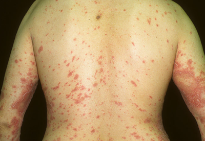 what is psoriasis man back