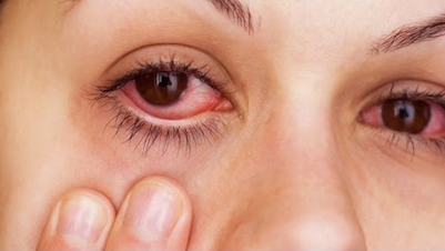 Eye Allergies Allergy of the Eyes