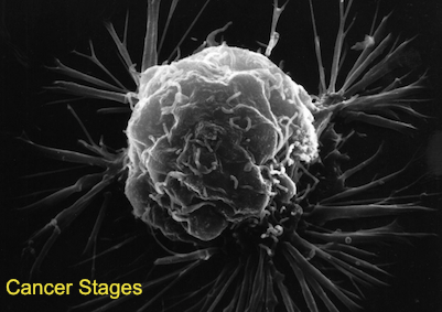 Mesothelioma Stages