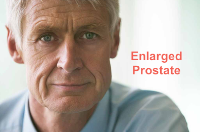 Enlarged Prostate Cancer And Colitis