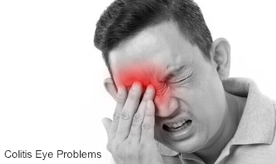 Colitis Eye Problems