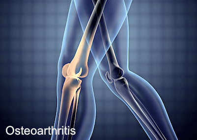 osteoarthritis knee joint pain