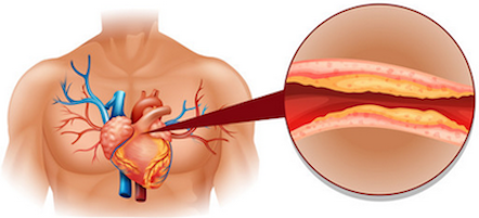 cholesterol heart disease diagram