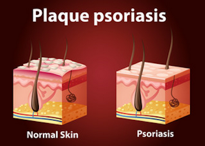 Plaque Psoriasis Inflammation Causes