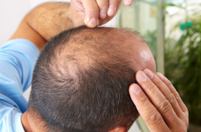 Scientific Techniques to Prevent Baldness