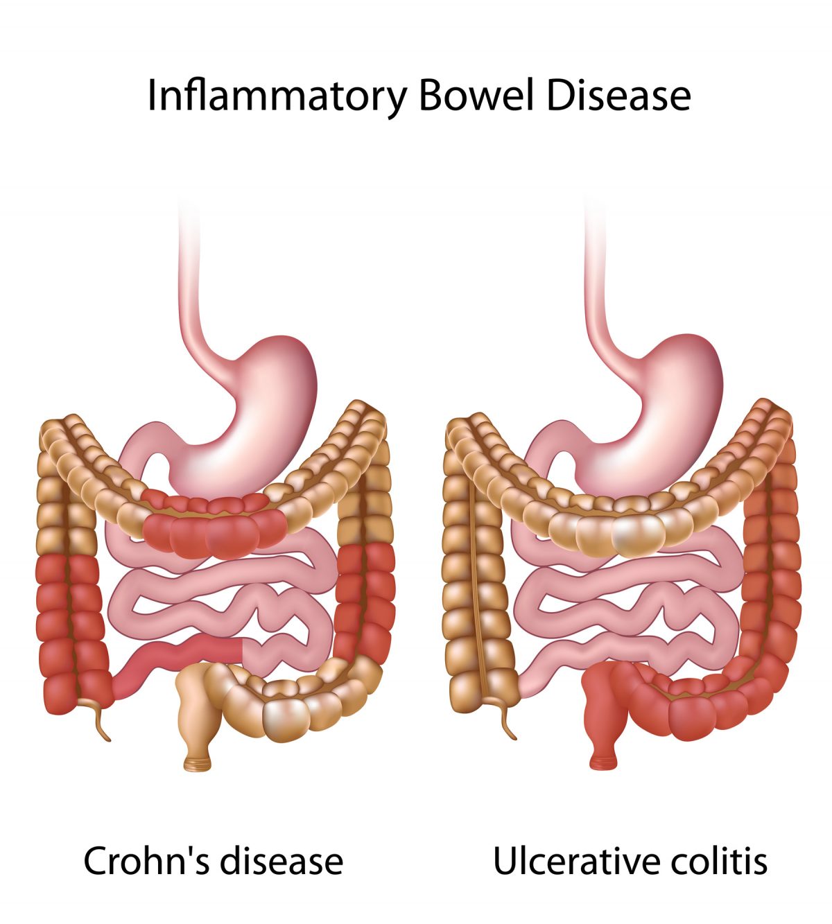 When Can Crohn’s Disease Require Colon and Rectal Surgery